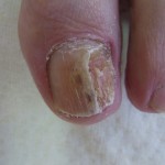 schimmelnagel voor de nagelreparatie