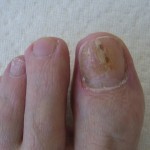 schimmelnagel na de nagelreparatie