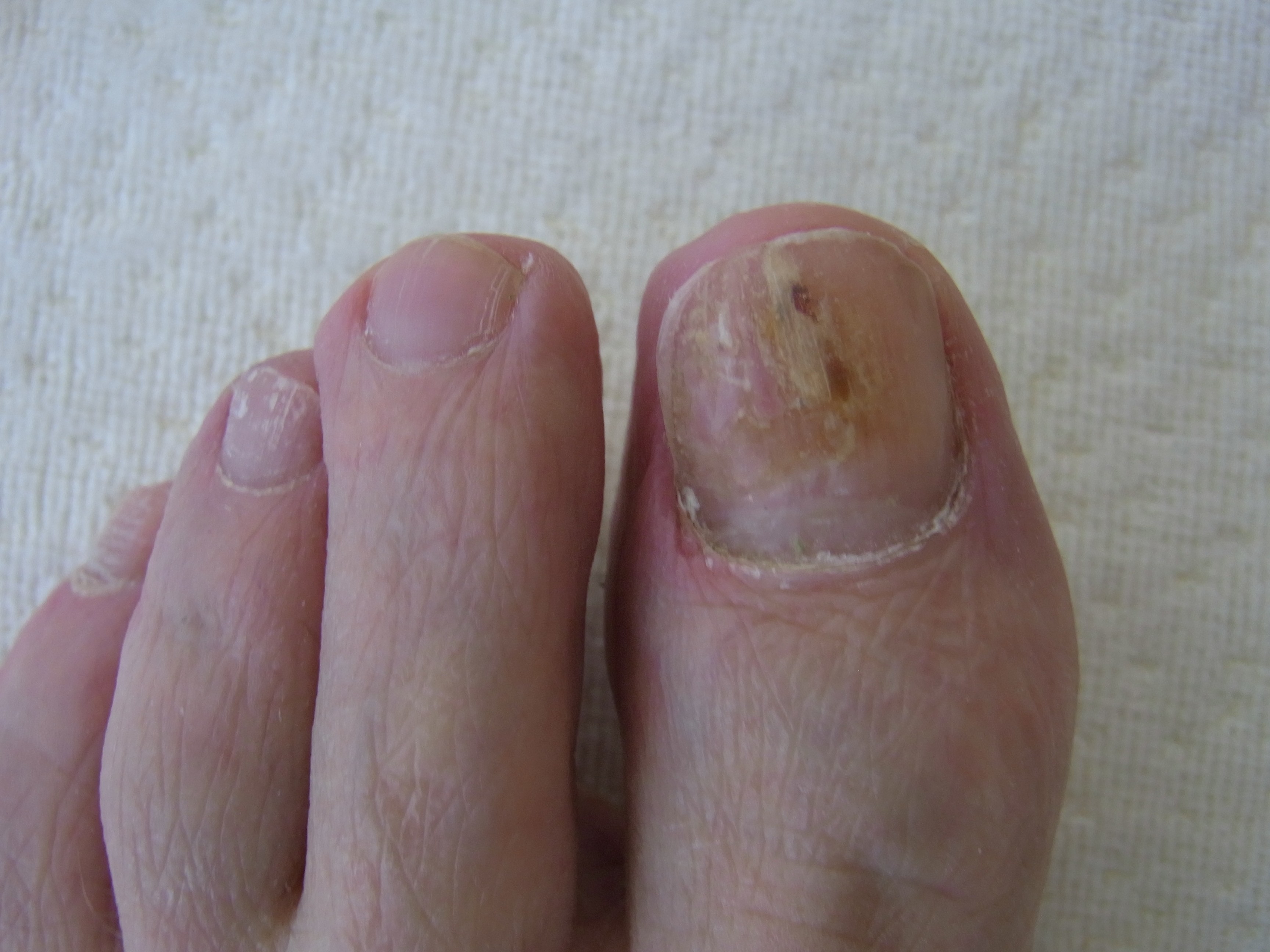 Accountant Sluiting Verhoogd nagelreparatie bij teennagels
