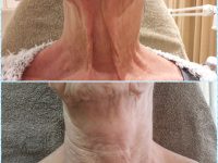 Fibroblast Hals Lift