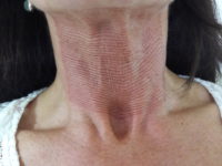 Fibroblast Hals Lift