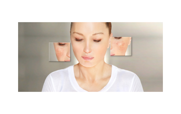 Rosacea en couperose