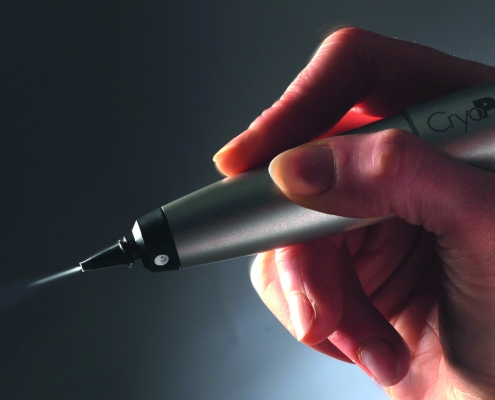 Cryotherapie met cryopen