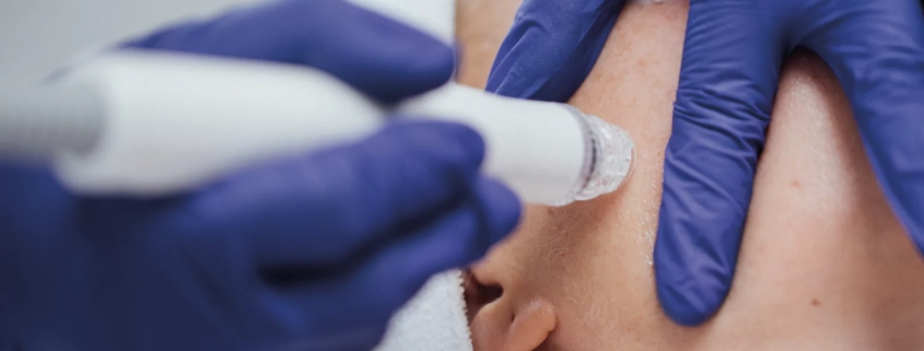 ONA Hydrodermabrasie-facial